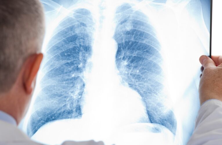 Científico de UofL recibe $ 6.7 millones para aprender cómo los metales causan cáncer de pulmón.