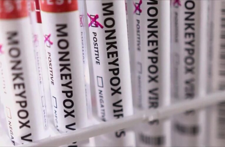 Los funcionarios de salud de Louisville ofrecen consejos para evitar la viruela del mono después de que se confirmara el primer caso de Indiana