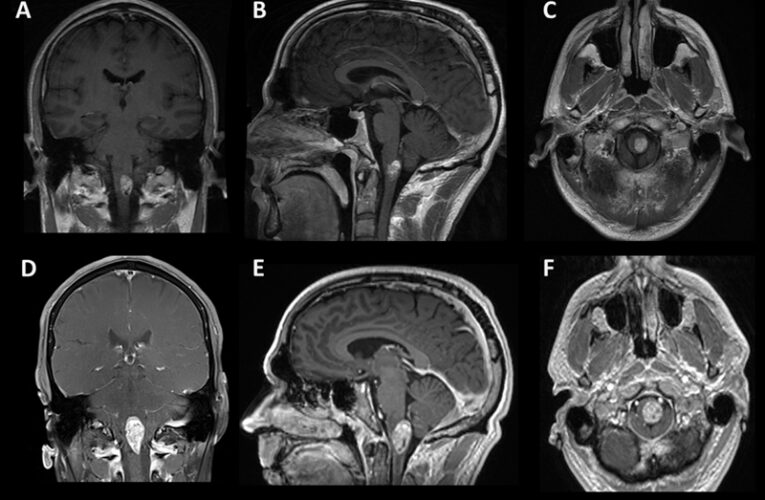 Los médicos de UofL Health son los primeros en el estado en utilizar el tratamiento centralizado del cáncer de cerebro