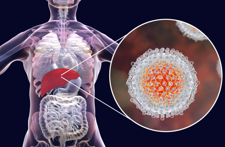Menos de 1 de 3 enfermos con hepatitis C en EEUU recibe cura