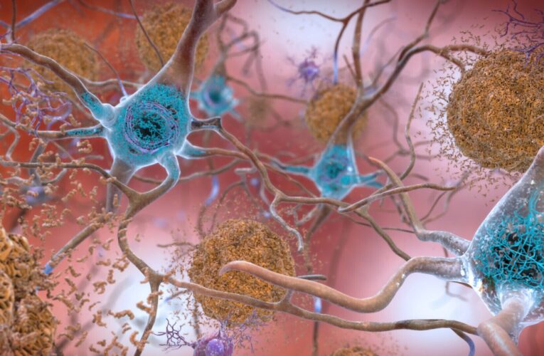 El fármaco frena el Alzheimer, pero ¿puede marcar una diferencia real?