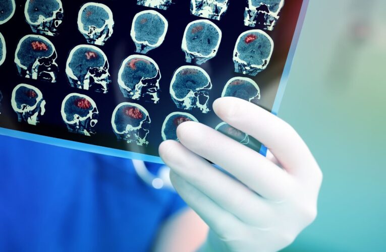 Medicamento prometedor para el Alzheimer en estudio en el Centro Sanders-Brown de UK.