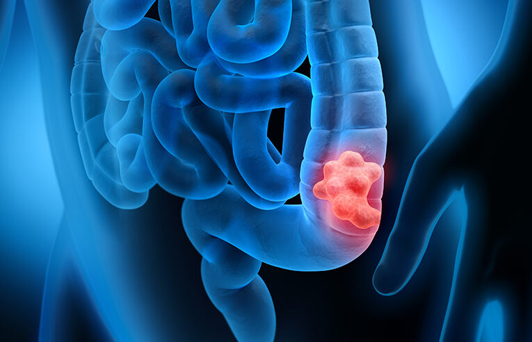 Cáncer colorrectal: La mejor prueba de detección es la que te haces tú