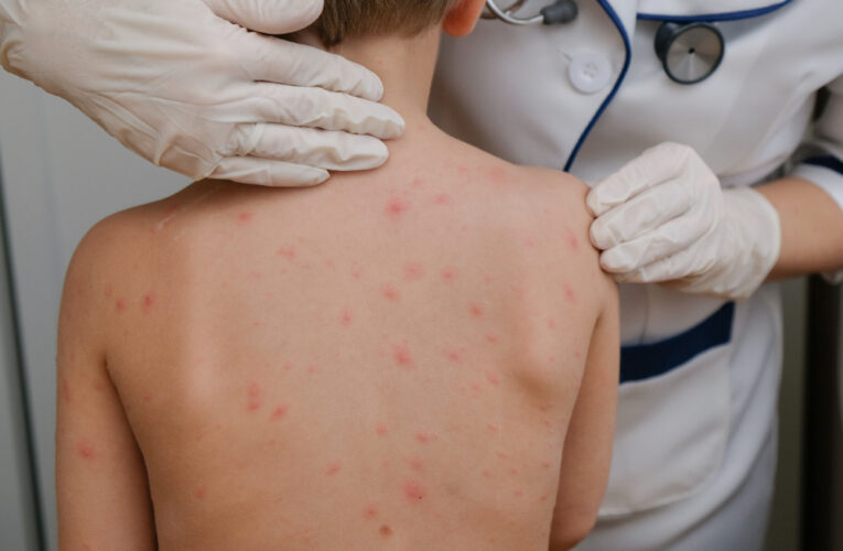 Los funcionarios de salud del área metropolitana de Louisville ven un aumento  en los niños diagnosticados con varicela