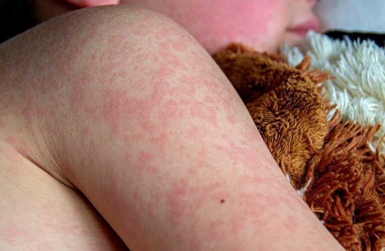 A medida que el brote de sarampión se acerca a los 600 casos, aumentan los temores de propagación en guarderías y áreas urbanas.