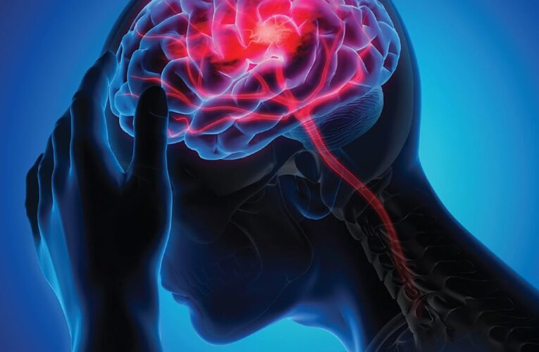 UofL y UofL Health investigan nuevas vías para el tratamiento de accidentes cerebrovasculares isquémicos